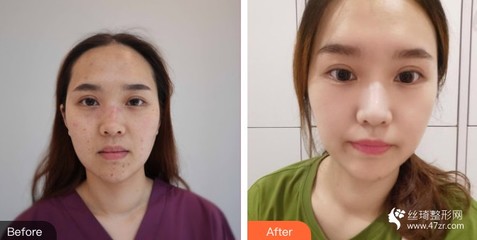 点痣后多久不能晒太阳