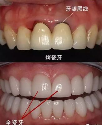 烤瓷牙和全瓷牙哪种好