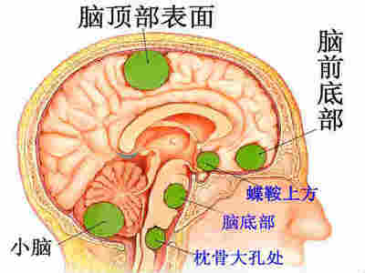 脑瘤怎么治疗