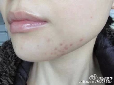 长痘痘吃什么会留痘印