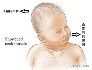 新生儿斜颈