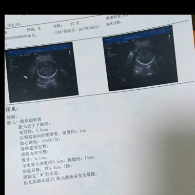 胎儿七个月双顶径标准