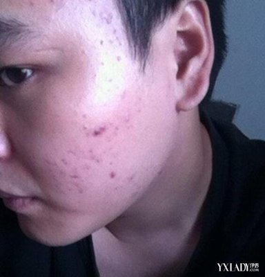 激素不平衡造成的痘痘