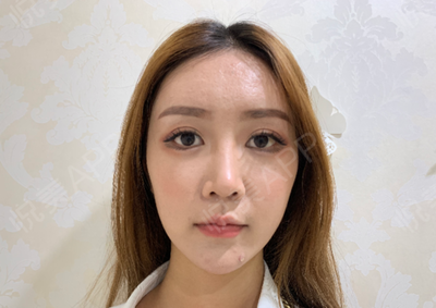 耳软骨隆鼻容易歪吗
