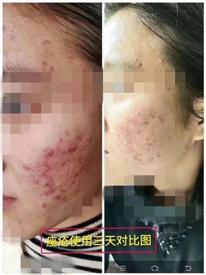 暗疮痘痘怎么治疗方法