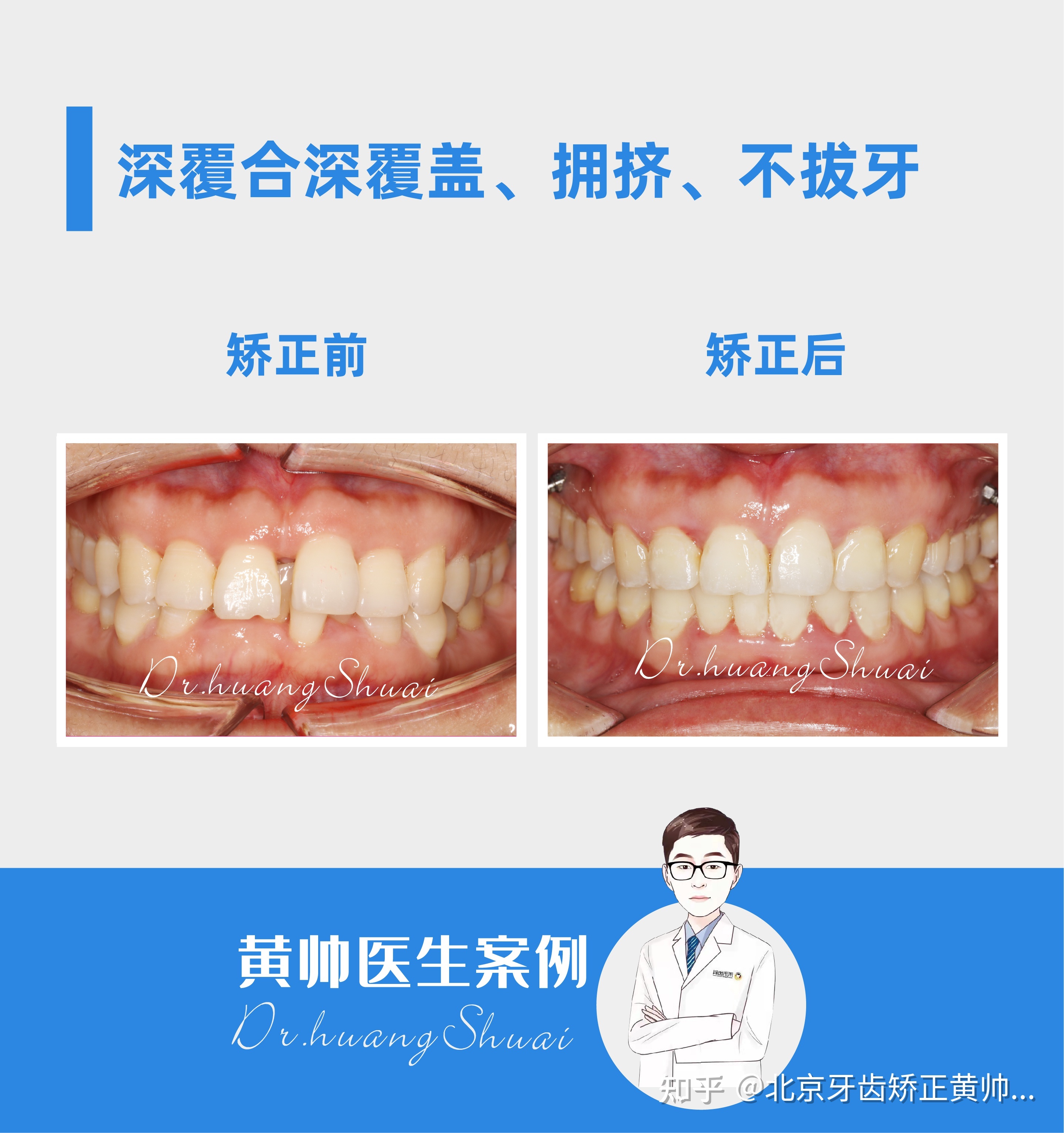 上牙深覆合矫正要多少钱