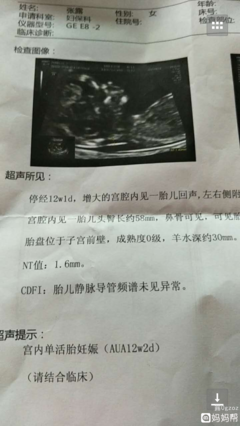 nt是查胎儿什么的