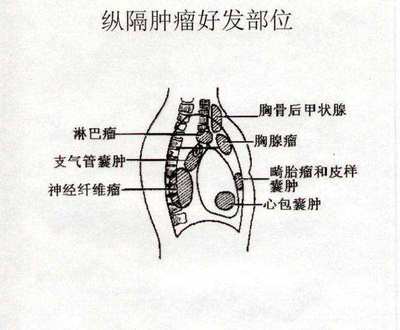 纤维腺瘤怎么治疗