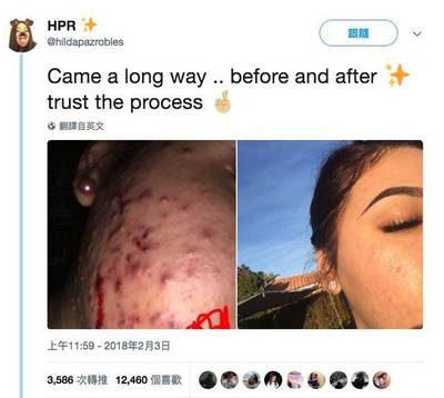 痘痘肌可以用蜂蜜敷脸吗