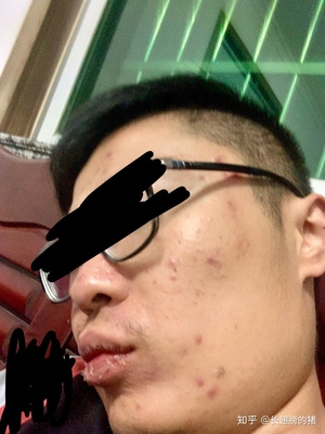 嘴唇边上长痘痘肿了
