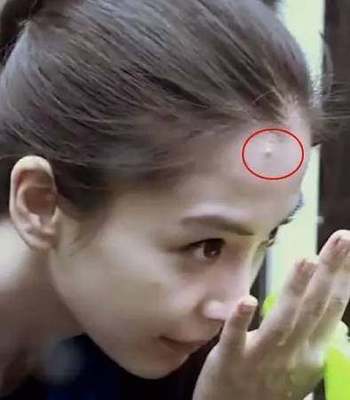 白色的大痘痘是什么原因