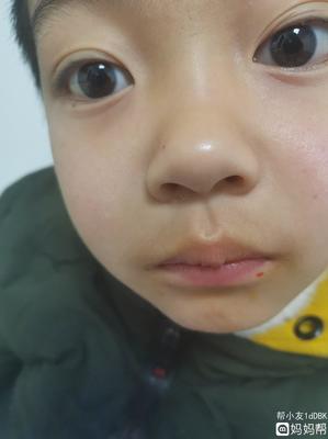脸上有痘痘不挤会怎样