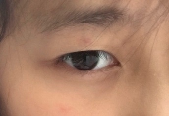 双眼皮厚