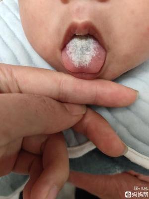 宝宝舌头连多少正常
