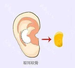 取耳软骨隆鼻疼吗
