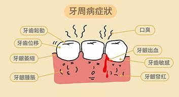 孕妇牙周炎