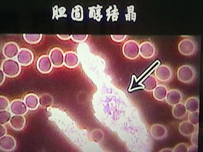 胆固醇结晶是怎么回事