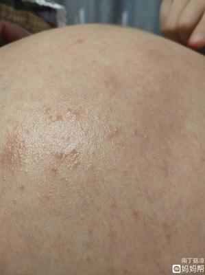 怀孕可以涂药膏吗