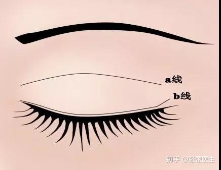 双眼皮有几种做法