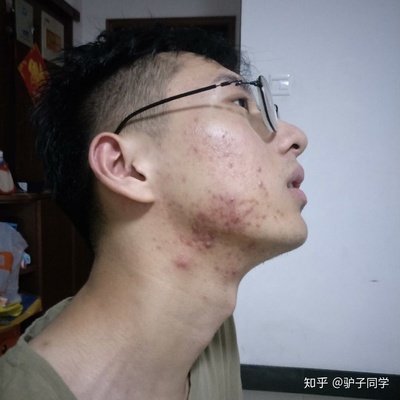 男生经常长痘痘要去角质吗