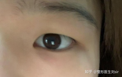 双眼皮有哪几种形状
