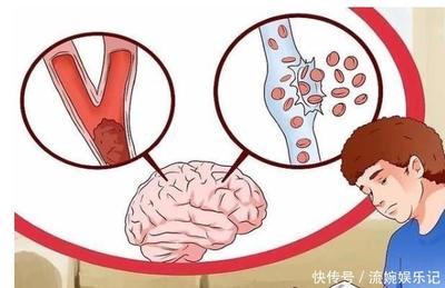 脑梗是怎么回事