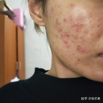天气热脸上起痘痘