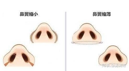 耳软骨隆鼻是永久的吗