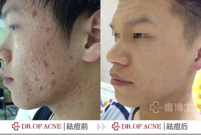 好多痘痘烦死了
