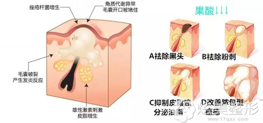 激光点痘痘