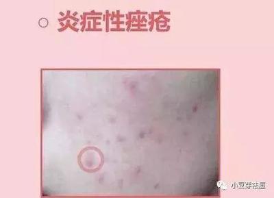 痘痘感染化脓多会消