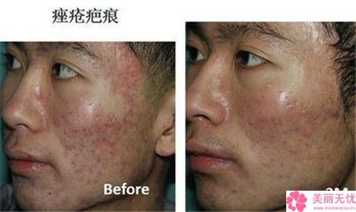 痘印怎么处理