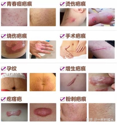 怎么判断自己是疤痕体质
