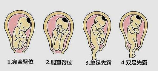 孕晚期胎儿姿势