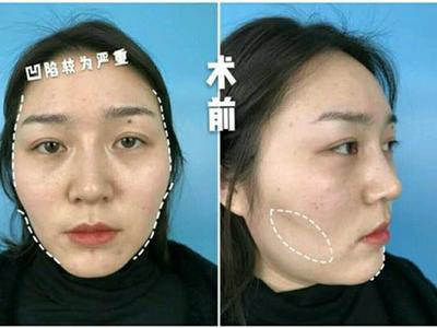 瘦脸针能瘦脸么