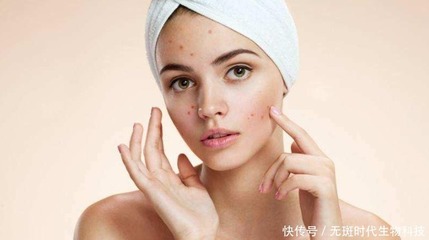 痘痘肌多久用一次清洁