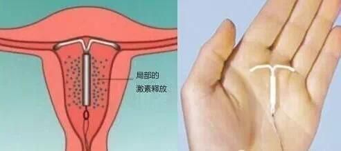 上环久了会影响怀孕吗