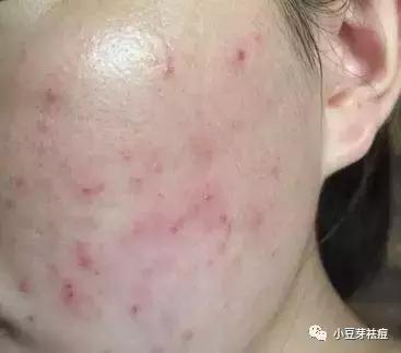 美容院能治好痘痘吗