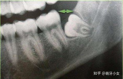 拔牙之后能吃什么