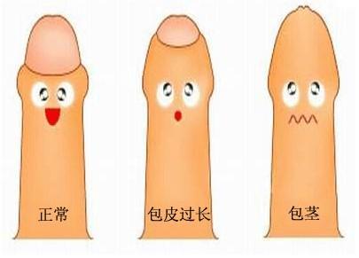 包皮垢是怎么回事