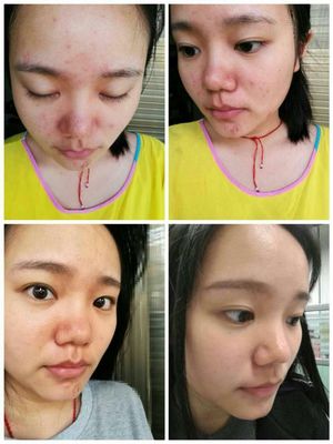 脸上有痘痘适合什么精华