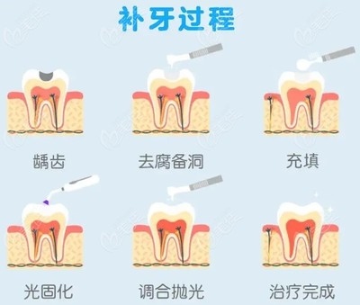 补牙整套多少钱