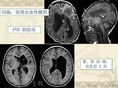 孕32周出血是怎么回事