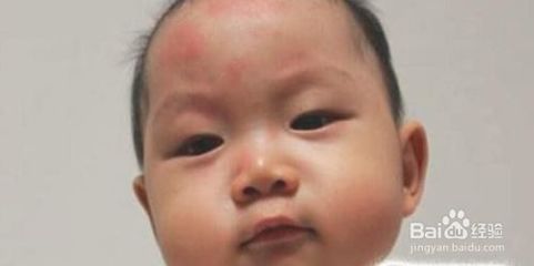 宝宝单纯发烧没有其他症状