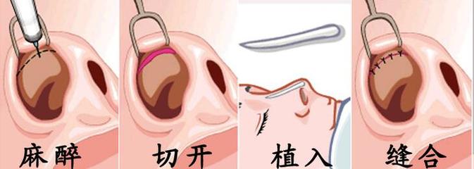 假体隆鼻恢复过程