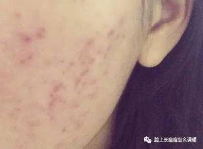 有红色的痘痘痘印