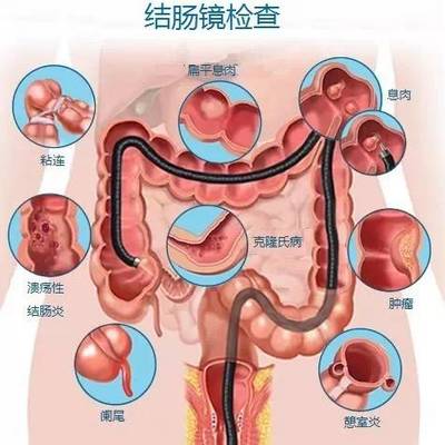 结肠息肉怎么治疗