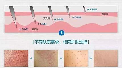 水光针和光子嫩肤哪个好