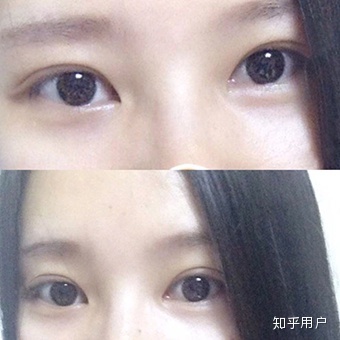 割完双眼皮忌口多久