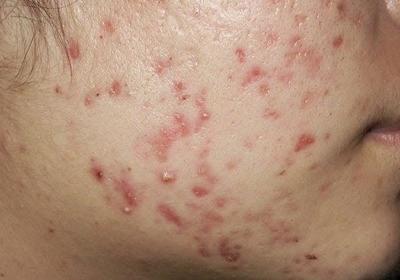 痘痘和粉刺啥区别